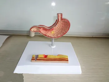 Модел на стомашна анатомия Стомашно-чревен тракт Модел на стомашна язва Храносмилателна система